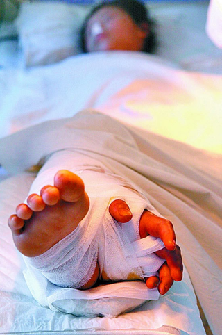 Illustration for article titled Doctors Save Girl's Hand By Grafting It To Her Leg For 3 Months